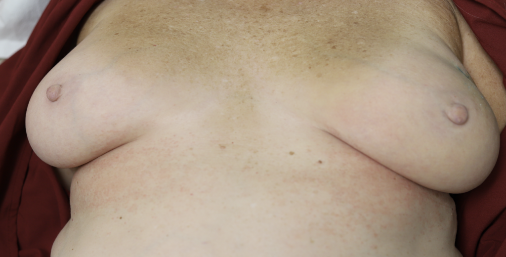 dermatitis from chloraprep